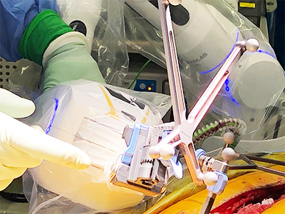 ロボット脊椎手術（Cirqロボットアームシステム）