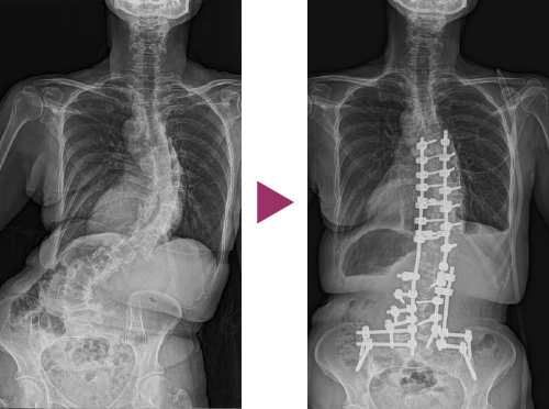 図11：成人脊柱側彎症の手術前と後の比較写真4