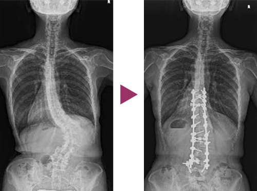 図11：成人脊柱側彎症の手術前と後の比較写真6