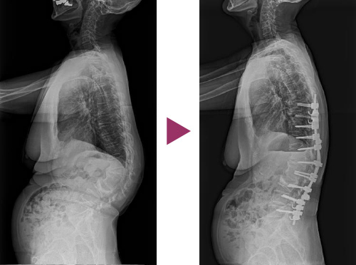 図12：成人脊柱後彎症の手術前と後の比較写真1