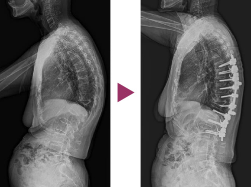 図12：成人脊柱後彎症の手術前と後の比較写真2