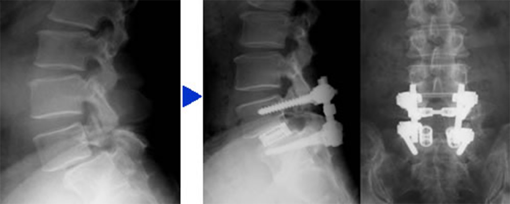 図2：腰椎すべり症に対する除圧ならびにインストゥルメンテーション手術を用いた脊椎固定術