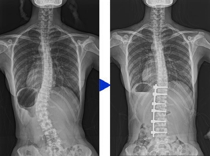 図10-2：胸腰椎カーブのレントゲン写真
