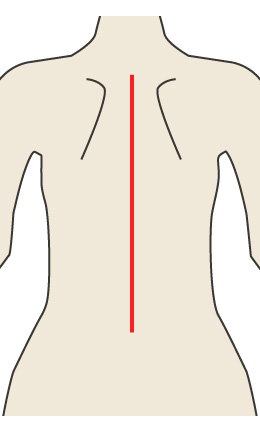 図8-1：後方矯正固定術の切開イメージ