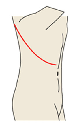 図9-1：従来の前方矯正固定術（長い斜めの切開）