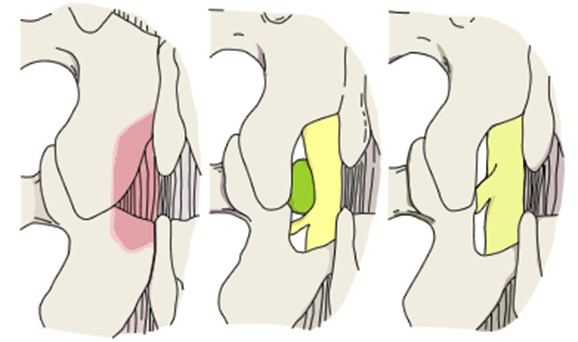 図3-2：椎間板ヘルニアの摘出術