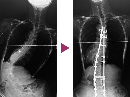 図11：成人脊柱側彎症の手術前と後の比較写真1