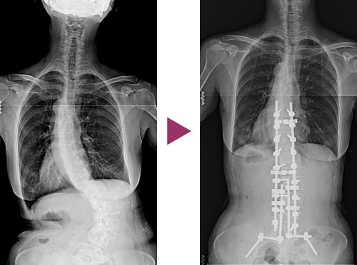 図11：成人脊柱側彎症の手術前と後の比較写真2