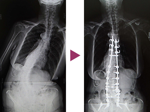 図11：成人脊柱側彎症の手術前と後の比較写真3