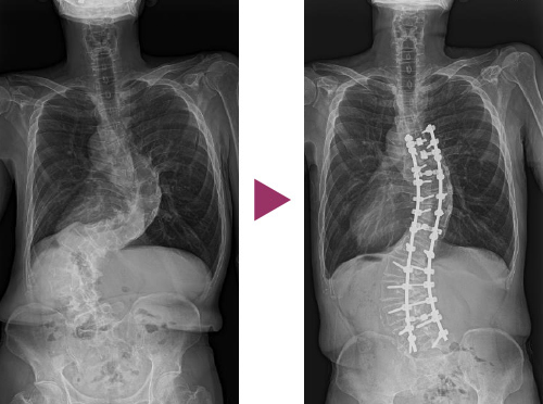 図11：成人脊柱側彎症の手術前と後の比較写真5